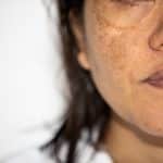 a close up photo of a woman with a skin condition