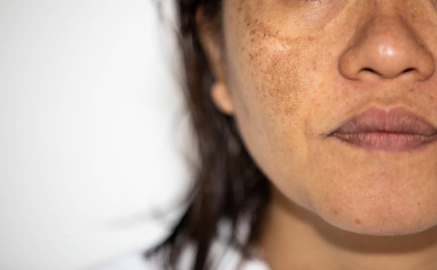 a close up photo of a woman with a skin condition