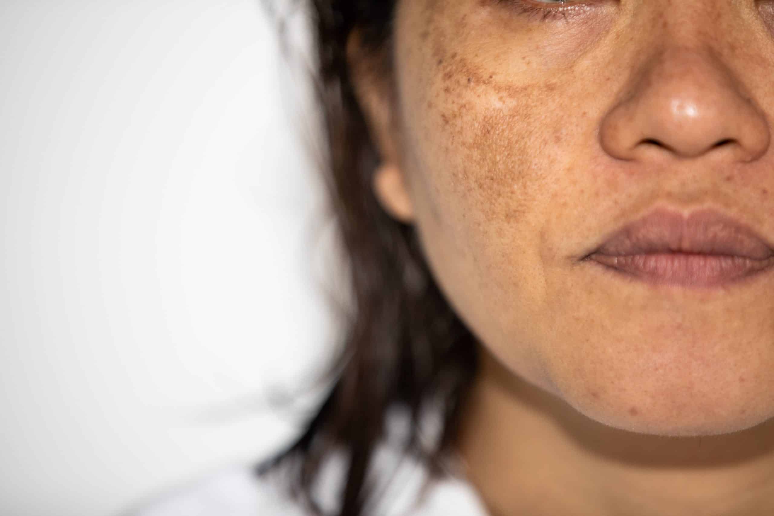 Dark Spots on Face (Melasma): Causes and Treatment